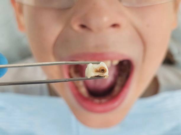 Best Emergency Tooth Extraction in Oakes, ND
